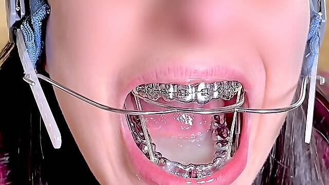 Braces HEADGEAR & HERBST cum in mouth